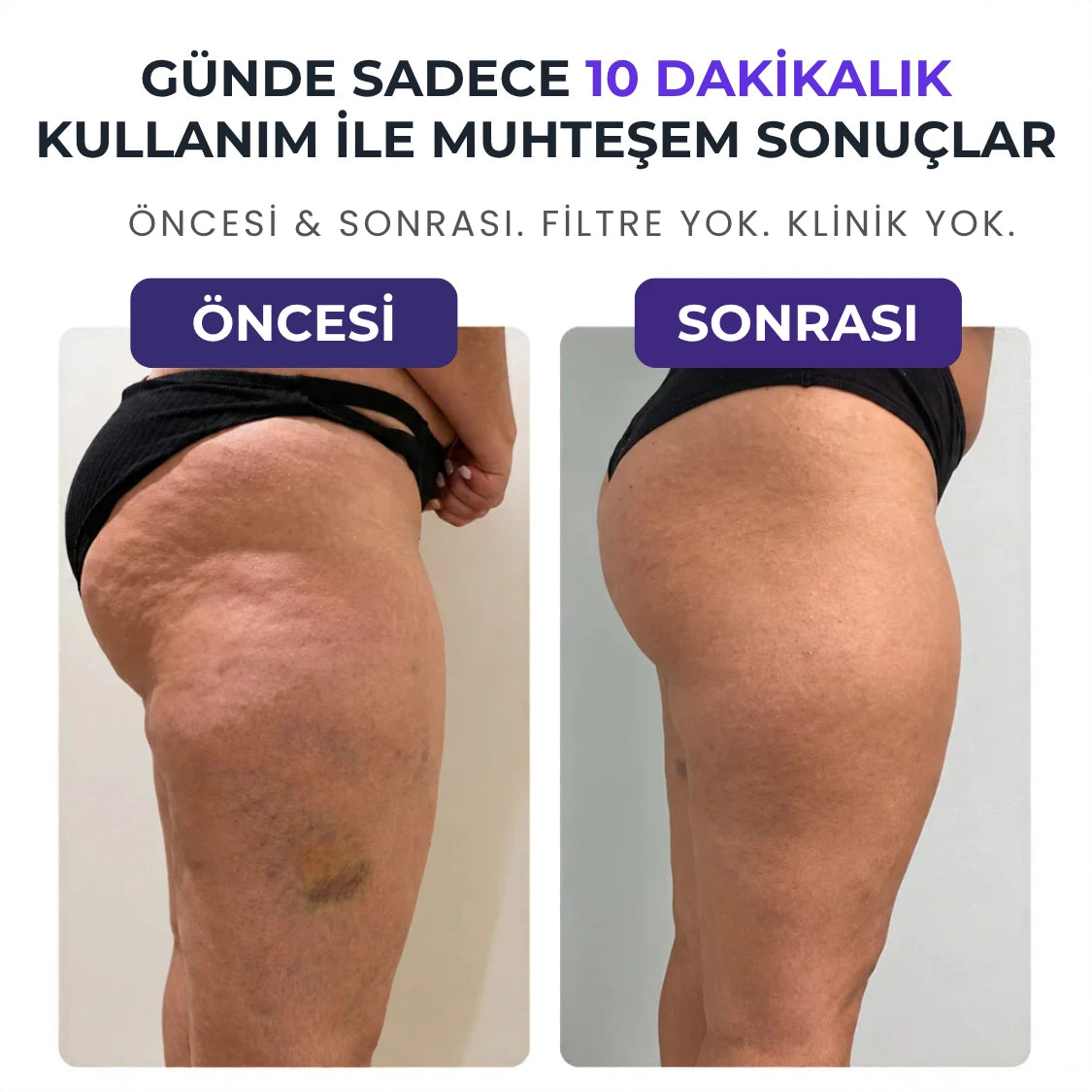 VELNORA™ Şarjlı Roller Masaj Aleti | Selülit Karşıtı, Vücut Sıkılaştırıcı ve Şekillendirici
